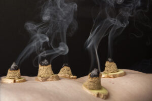 moxa-op-gember-acupunctuurdokter