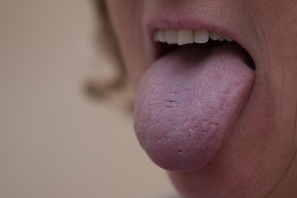 chinese tongdiagnostiek