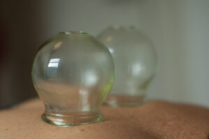 Wat is Cupping - Acupunctuurdokter.nl