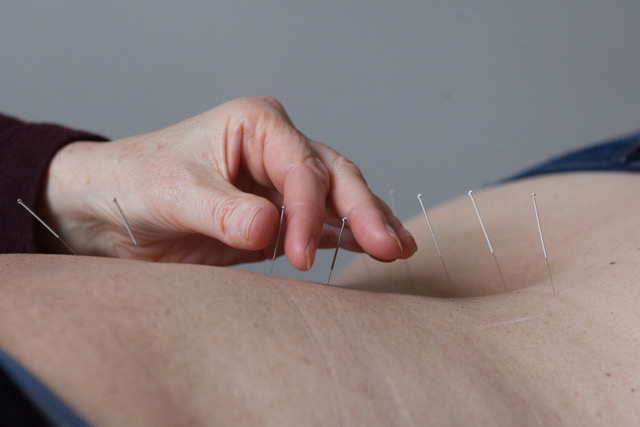 acupunctuurdokter.nl acupunctuur